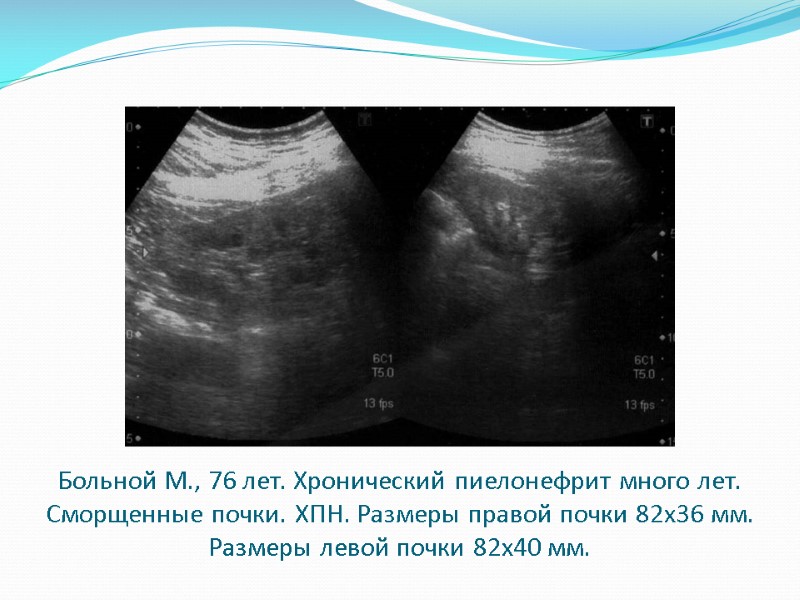 Больной М., 76 лет. Хронический пиелонефрит много лет. Сморщенные почки. ХПН. Размеры правой почки